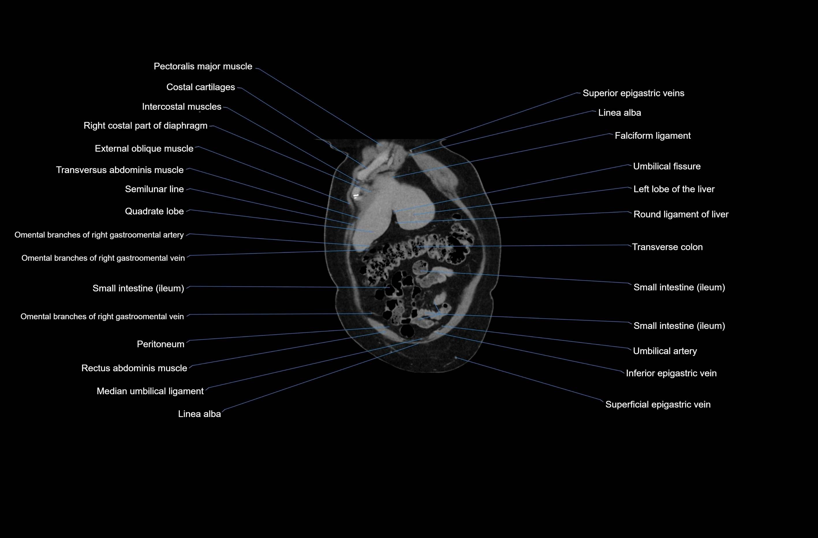 CT abdomen coronal cross sectional anatomy labelled radiology image-00013.webp